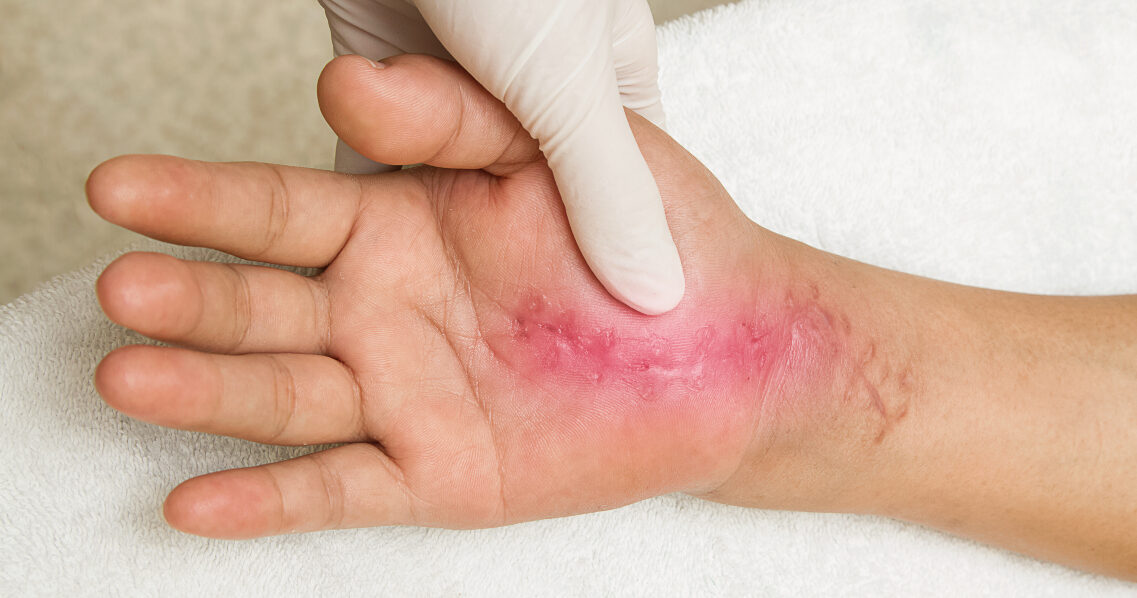 How Proper Wound Care Helps the Healing and Scarring Process